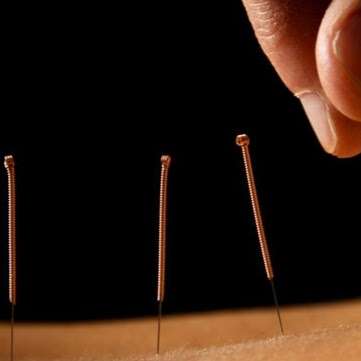 Photo: Acupuncture Benalla